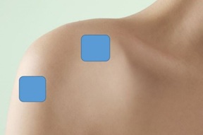 Periarthritis of shoulder