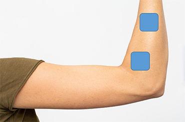Tennis Elbow
